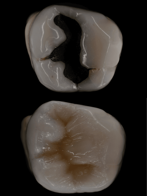 replace amalgam fillings with dental crowns